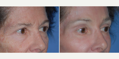 Eyelid Surgery before and after photo