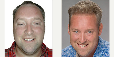 Hair Transplant before and after photo