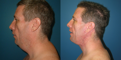 Neck Lift before and after photo