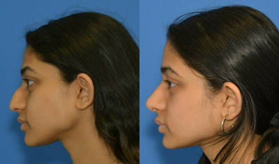 Rhinoplasty before and after photo