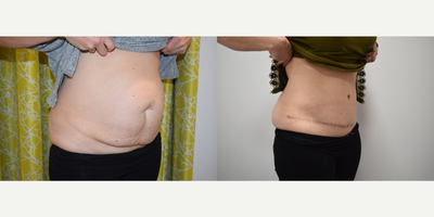 Diastasis Recti Repair before and after photo