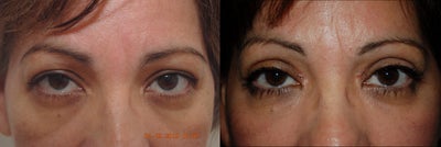 Eyelid Surgery before and after photo