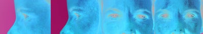 Eyelid Surgery before and after photo