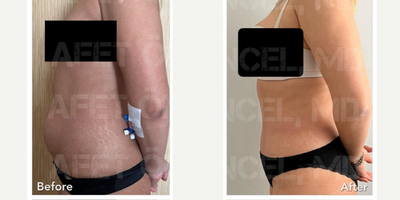 Tummy Tuck before and after photo