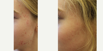 Accutane before and after photo