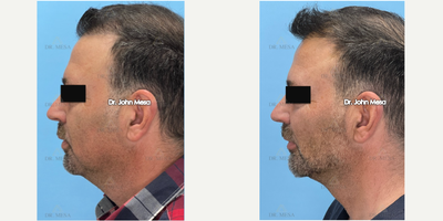 AccuTite before and after photo