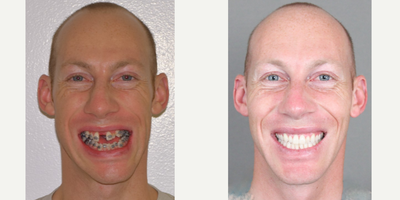 Facial Reconstructive Surgery before and after photo