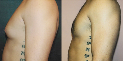 Gynecomastia Surgery before and after photo