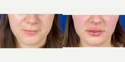 Lip Fillers before and after photo