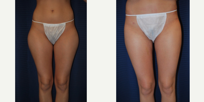 Liposuction before and after photo