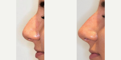 Nonsurgical Nose Job before and after photo