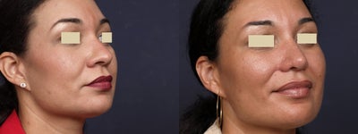 Rhinoplasty before and after photo