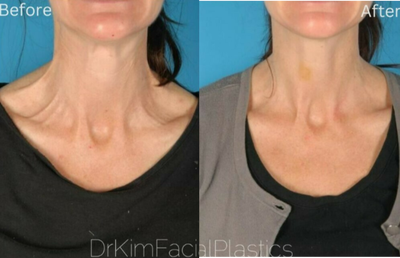 Botox before and after photo