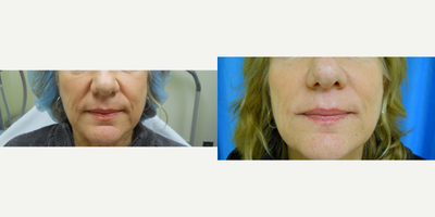 Dermal Fillers before and after photo
