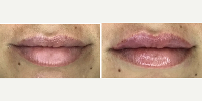 Juvederm before and after photo