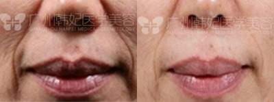 Microneedling RF before and after photo