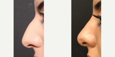 Rhinoplasty before and after photo