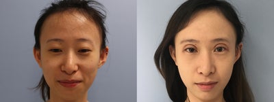 Eyelid Surgery before and after photo