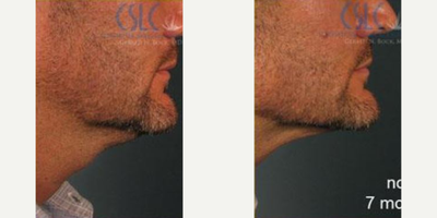Liposuction before and after photo