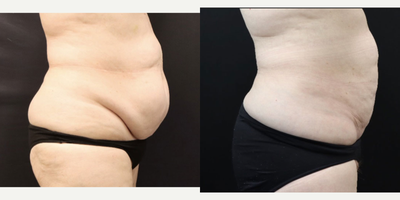 Liposuction before and after photo