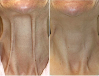 Botox before and after photo