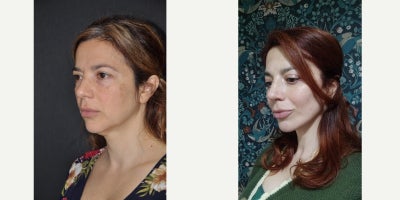 Deep Plane Facelift before and after photo
