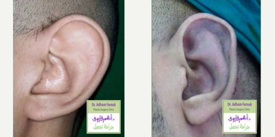 Ear Surgery before and after photo