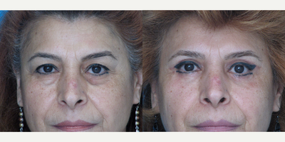 Eyelid Surgery before and after photo