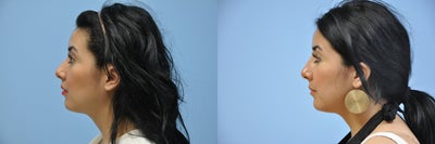 Nonsurgical Nose Job before and after photo