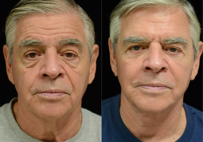 Dermal Fillers before and after photo