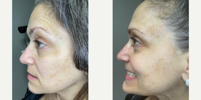 Botox before and after photo