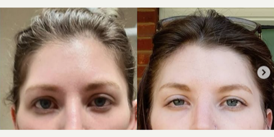 Dysport before and after photo