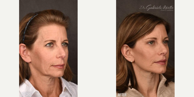 Facelift before and after photo