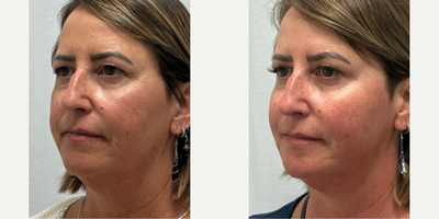 Juvederm before and after photo
