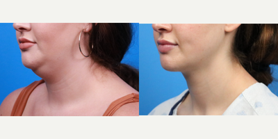 Liposuction before and after photo