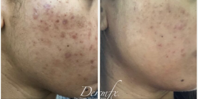 Agnes RF before and after photo