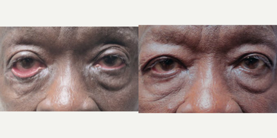 Eyelid Retraction Repair before and after photo