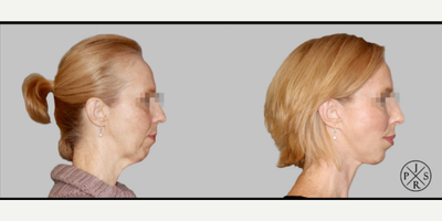 Facelift before and after photo