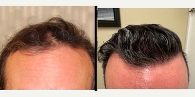 FUE Hair Transplant before and after photo