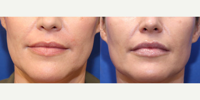 Lip Fillers before and after photo