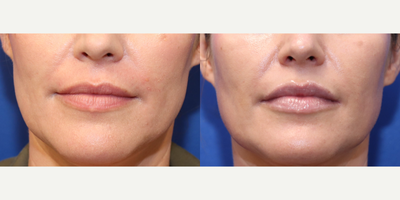 Lip Fillers before and after photo