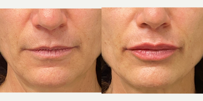 Lip Fillers before and after photo