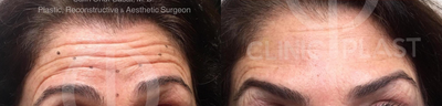 Botox before and after photo