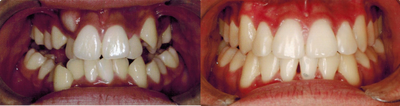Braces before and after photo