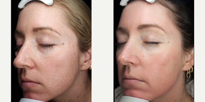 Clear and Brilliant before and after photo