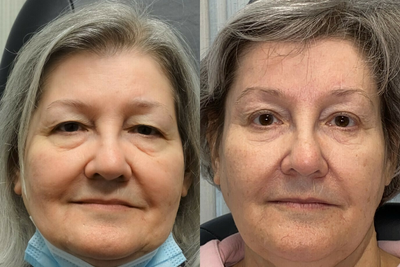 CO2 Laser before and after photo