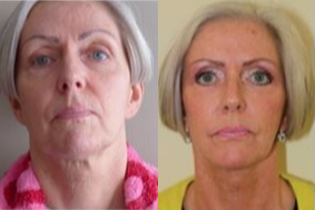 Facelift before and after photo