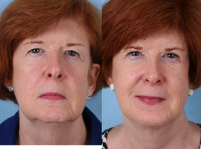 Facelift before and after photo