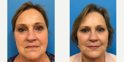 Facelift before and after photo