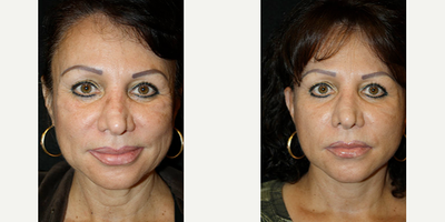 Mini Facelift before and after photo